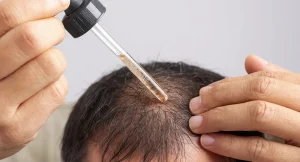 Calvitie : un essai clinique revendique 539% de croissance capillaire