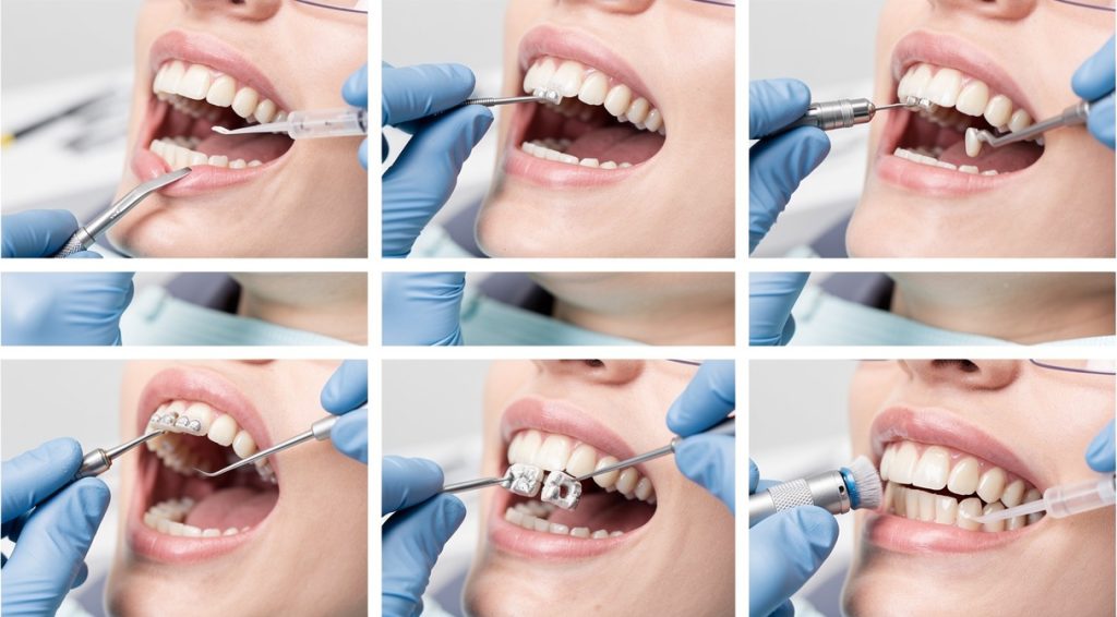 Comment desceller un bridge dentaire