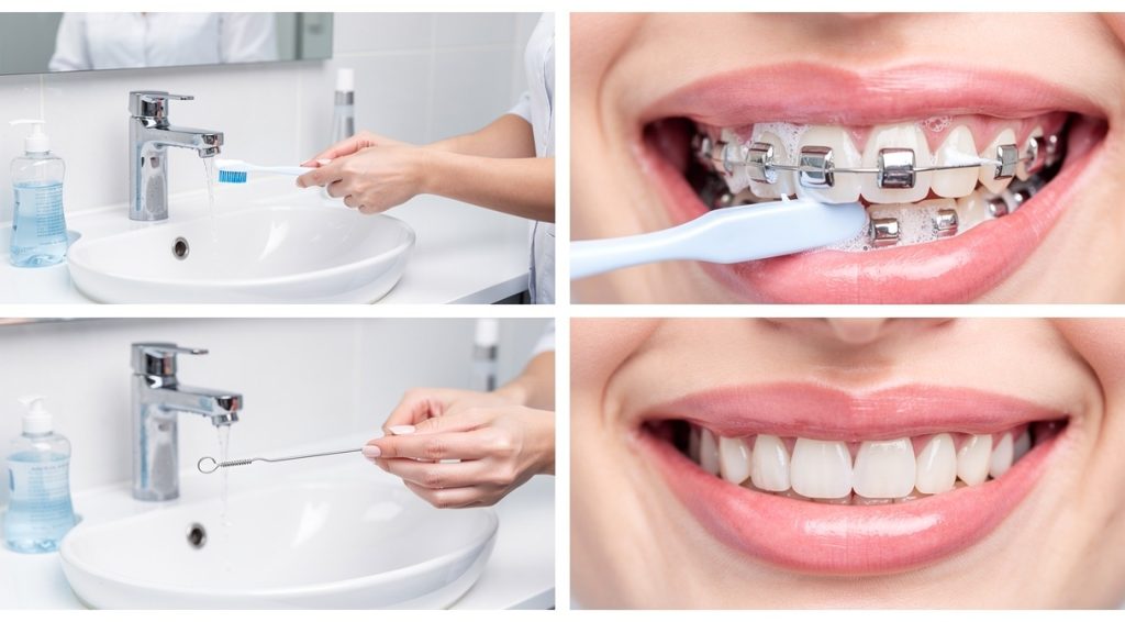 Comment nettoyer un bridge dentaire efficacement