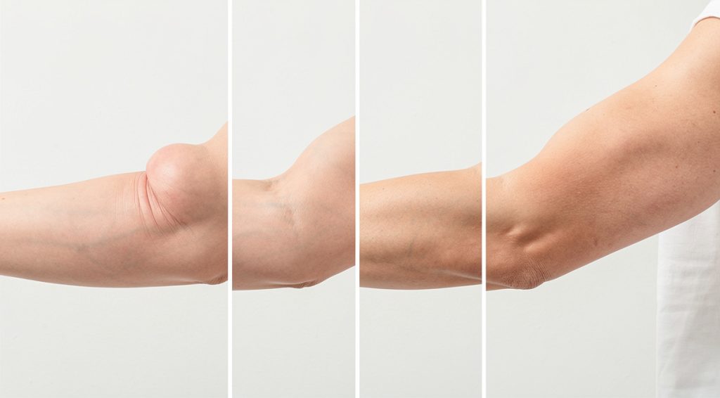 Coude qui gonfle : causes, symptômes et traitements