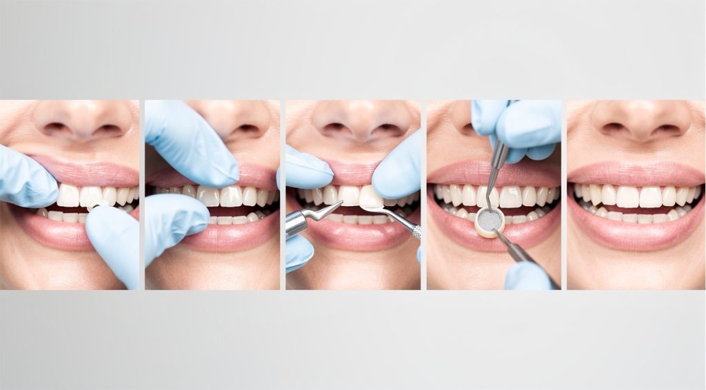 Couronne dentaire qui bouge : causes, solutions et prévention