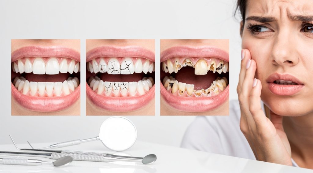 Dents qui se cassent maladie : causes, pathologies et solutions